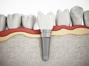 dentalimplants smile teeth dentures